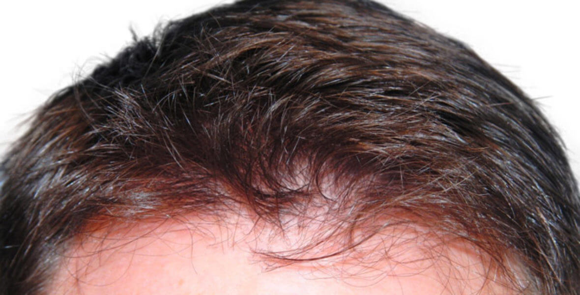 przeszczep włosów przed i po