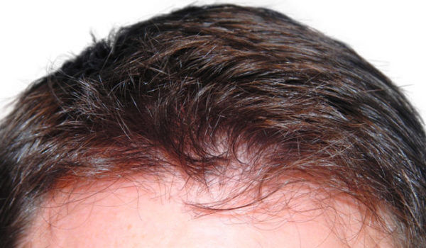 przeszczep włosów przed i po