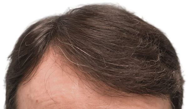 efekty przeszczepu włosów po